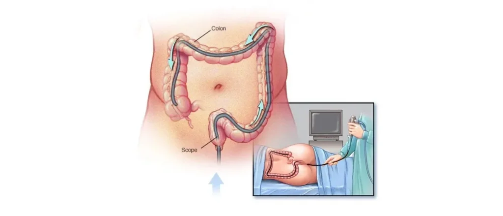 Advanced colonoscopy treatment at Assure Hospital