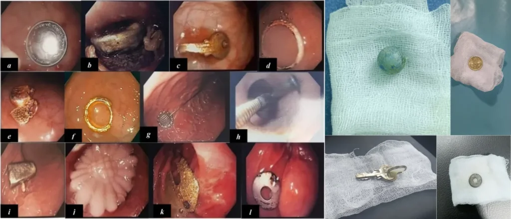 Deep Foreign Body Removal in narasaraopeta