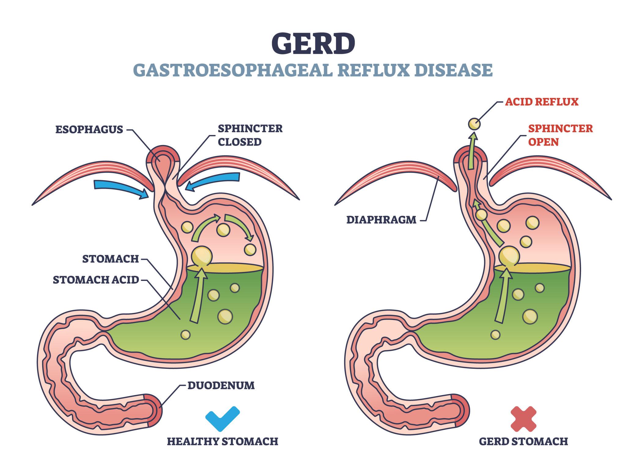 Read more about the article Acidity vs GERD: Understanding the Difference