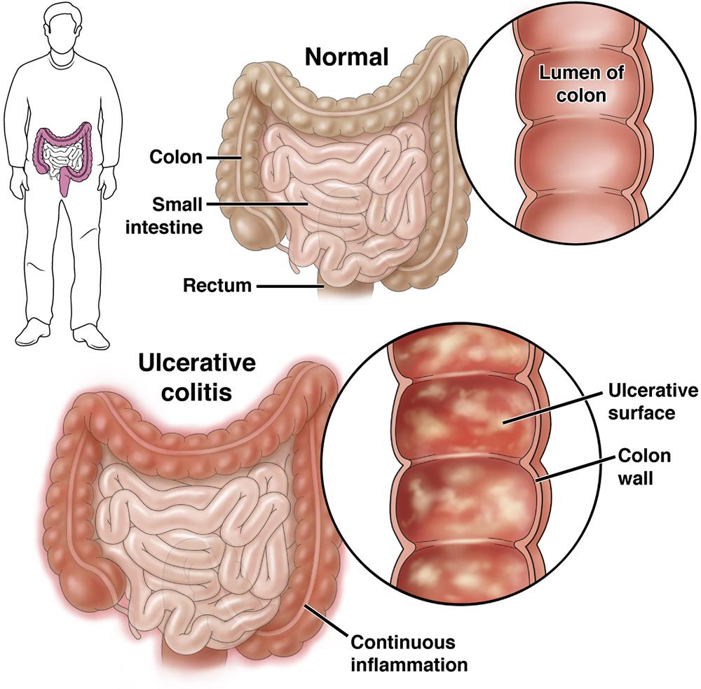 Read more about the article Colonoscopy for Early Detection of Colon Diseases